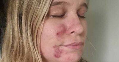 Mum felt 'like a monster' and hid her face from daughter when struck with cystic acne after Covid