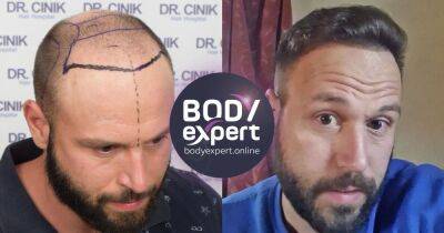 A hair transplant in Turkey could help with hair loss issues